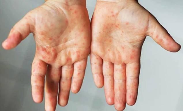 ২৪ ঘণ্টায় হামে ১২ শিশুর মৃত্যু, মোট মৃত্যু ১৩০