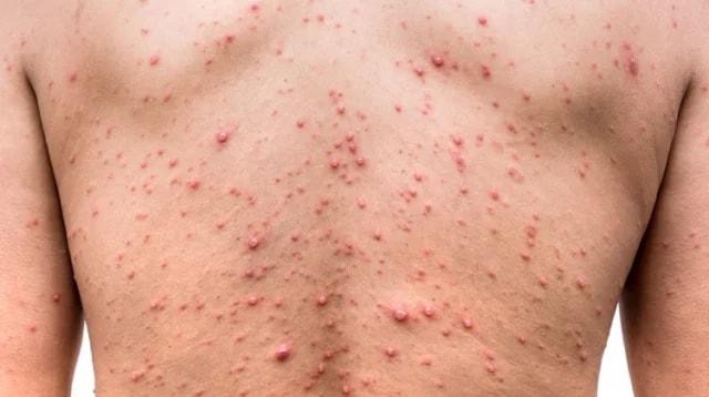 হাম সন্দেহে ২৪ ঘণ্টায় মৃত্যু ৫