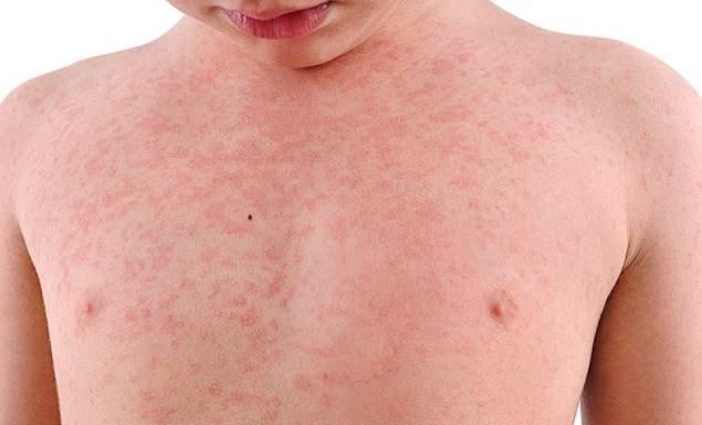 চট্টগ্রামে বাড়ছে হাম সংক্রমণ, নতুন শনাক্ত ৮