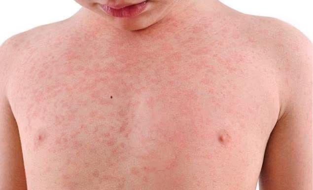 হামের উপসর্গে আরও ৪ শিশুর মৃত্যু